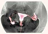 Female reproductive organs,X-ray