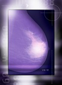 Healthy breast,X-ray