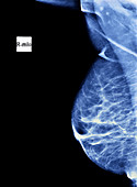 Normal breast,X-ray