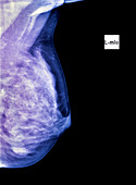 Normal breast,X-ray