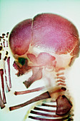 An Alizarin stained human foetus