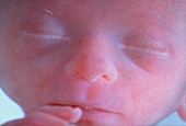 Face of a human foetus at five months