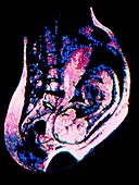 False-colour NMR scan of 8-month foetus in womb