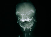 Facial X-ray of aborted foetus with cleft palate