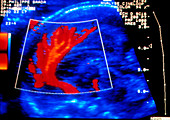 Doppler ultrasound of blood flow in foetal brain