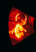 Ultrasound scan of a 21 week old human foetus