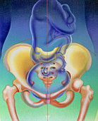 Artwork of foetal head presentation in the pelvis