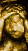 Coloured 3-D ultrasound scan: foetus holding head