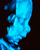 3-D ultrasound scan of a foetus' head