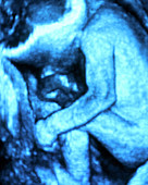 3-D ultrasound scan of a foetus