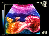 Ultrasound scan of 20 week old foetus (side view)