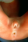 Foetal genitalia