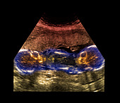 Twin foetuses,ultrasound