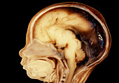 Sectioned foetus' head