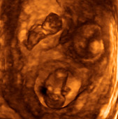 Triplets,3-D ultrasound scan