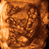 12 week quadruplets,4-D ultrasound scan