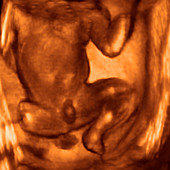 Foetal genitalia,3-D ultrasound scan