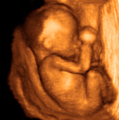 22 week foetus,3-D ultrasound scan