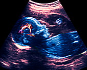 Blood flow in foetal brain,ultrasound