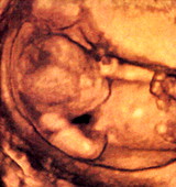 Foetus,3-D ultrasound scan