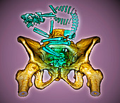 Breech position foetus,CT scan