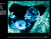 Ultrasound of foetus at 12 weeks