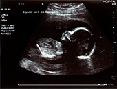 Ultrasound of foetus at 20 weeks