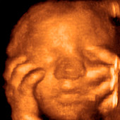 Foetus' face,3-D ultrasound scan