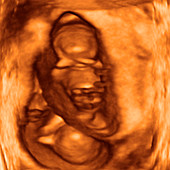 10 week twin foetuses,3-D ultrasound