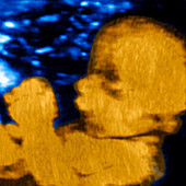 8 month old foetus,ultrasound scan