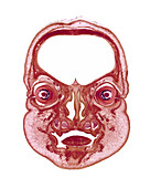Foetal head
