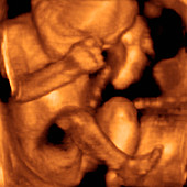 Foetus,3-D ultrasound scan