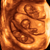 Triplet foetuses,3-D ultrasound scan