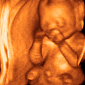 Foetus,3-D ultrasound scan