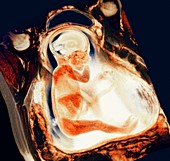 8 month foetus,MRI scan
