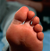 Healthy toes and sole of a woman's foot