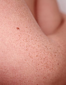 Freckled skin