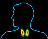 Coloured gamma scan of normal human thyroid gland