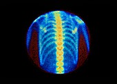 Normal bone scan of chest: posterior view