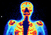 Coloured radionuclide bone scan of upper body