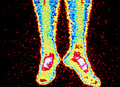 Coloured radionuclide bone scan of lower legs