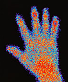 Gamma scan scintigram of a hand