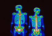 Male skeleton,gamma scan