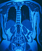 MRI scan of thorax and abdomen of an elderly woman