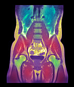 Abdominal scan,MRI