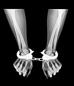 X-ray of a person's wrists in handcuffs