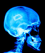 Security chip in a human skull