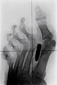 X-ray of bullet in foot of Boer War soldier,1899