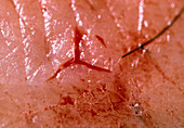 Bite mark left by a medicinal leech in human skin