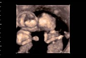 Twin foetuses, 4D ultrasound scan